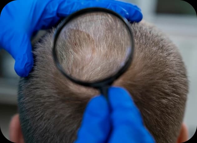 Saç Kıran Nedir? Alopecia Areata Hakkında Bilinmesi Gerekenler