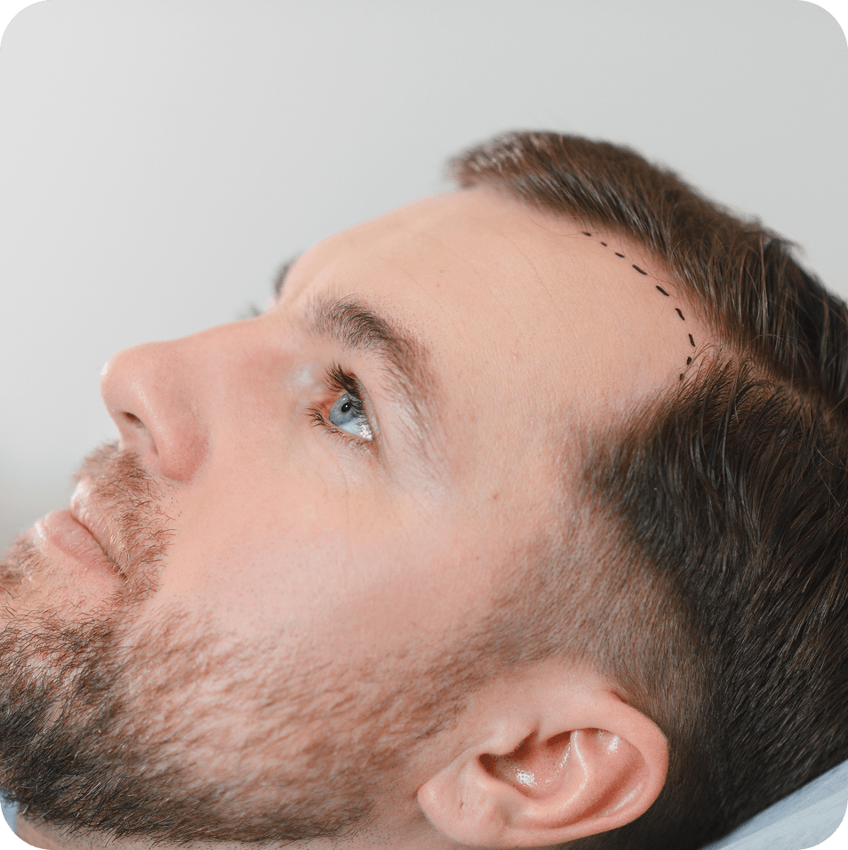 Saç Ekim Öncesi Paketi Neden Önemlidir?