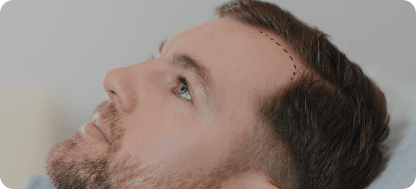 Saç Ekimi Öncesi Hazırlık