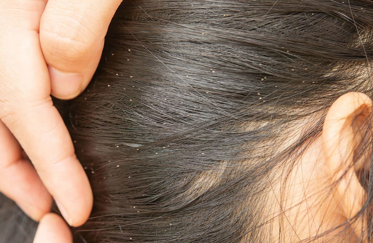 Saç Derisinde Kabuklanma, Pullanma ve Kaşıntı Neden Olur?