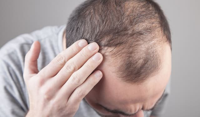 Erkeklerde Saç Dökülmesi Neden Olur? Belirtileri ve Tedavi Süreci