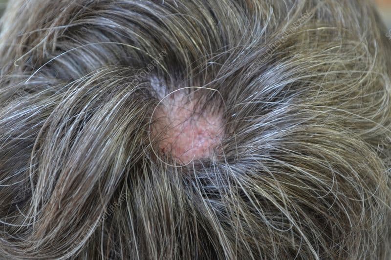 Saç Kıran (Alopesi Areata) Nedir? Belirtileri ve Tedavi Yöntemleri